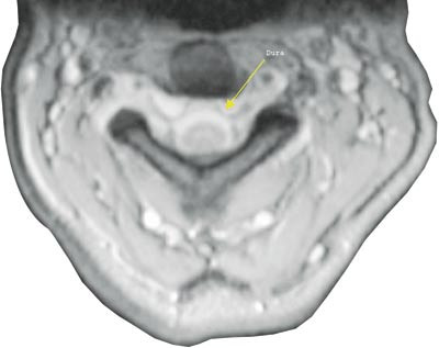 Figur 2  MR cervikal medulla av pasient 1. Aksialt snitt i T2-vektet serie viser v&aelig;ske med signaltetthet som&hellip;