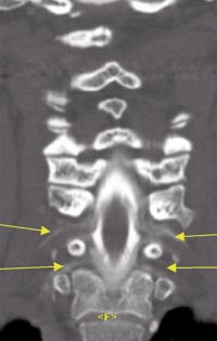Figur 3  CT-myelografi av pasient 1. I niv&aring; C6/C7 og C7/Th 1 p&aring;vises bilateral ekstravasering av kontrast langs nerver&oslash;ttene