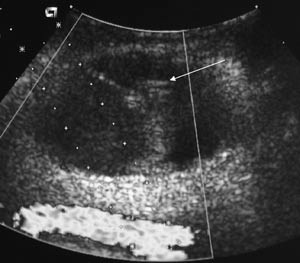 Figur 2  Samme pseudoaneurismet som figur 1 etter behandlingen. Trombin er nylig injisert. Sirkulasjonen er opphevet. Til&hellip;