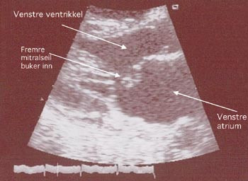 Figur 2  Transtorakal ekkokardiografi med fremstilling i parasternal langakseprojeksjon. Bildet viser at fremre mitralseil&hellip;