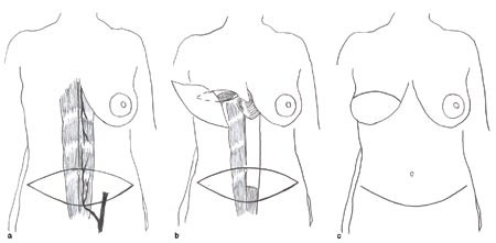 Figur 2  Skjematisk illustrasjon av brystrekonstruksjon med stilket tverrstilt rectus abdominis muskel/hudlapp. a)&hellip;