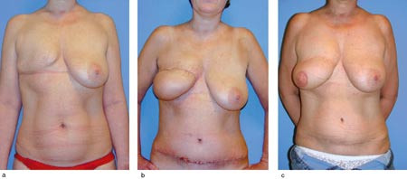 Figur 3  Brystrekonstruksjon med dyp nedre epigastrisk perforator hudlapp. 45 &aring;r gammel kvinne fikk foretatt h&oslash;yresidig&hellip;