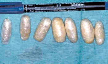 Figur 2  Pasient 2 kvitterte ut 60 sylinderformede pakker, diameter ca. 1,5 cm, lengde ca. 3,5 cm, med kokain. De var pakket&hellip;