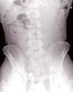 Figur 3  R&oslash;ntgen oversikt abdomen fra pasient 3 viser multiple fremmedlegemer (ca. 2 x 4 cm) i abdomen