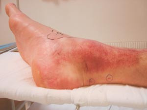 Figur 2  Fot bitt av hoggorm. Foto Alf &Aring;ge Pettersen