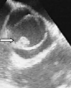 Figur 2  Trans&oslash;sofageal ekkokardiografi av pasient 3. Bildet viser en bikuspid aortaklaff med vegetasjoner