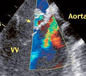 Figur 2  Trans&oslash;sofageal ekkokardiografi med langaksesnitt viser aorta, aortaklaffen og fremre mitralseil med vegetasjon (pil&hellip;