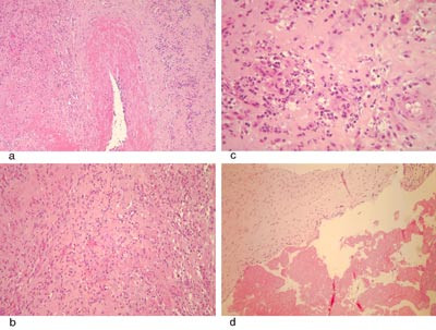 Figur 4  a) Snitt fra roten av mitralklaffen viser betennelsesprosess omkring st&oslash;rre kar med dominans av n&oslash;ytrofile&hellip;