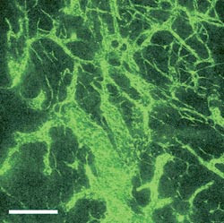 Figur 2  Karakteristisk utseende av blodkarene i en malign svulst. Bildet er tatt med konfokalt laserskanningmikroskop og&hellip;