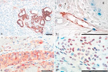 Figur 3  a) Glomeruloid karn&oslash;ste i malignt melanom; atypisk kardanning der endotelceller, pericytter og glatte muskelceller&hellip;