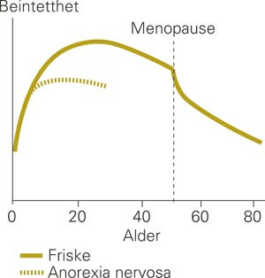 Osteoporose er vanlig hos pasienter med langvarig anorexia nervosa. Flere studier viser &oslash;kt risiko for brudd som f&oslash;lge av&hellip;