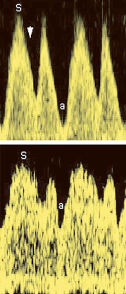 Figur 2  &Oslash;verst: Dopplerm&aring;ling i ductus venosus ved parvovirus B19-infeksjon i 25. svangerskapsuke viser to tegn p&aring; f&oslash;tal&hellip;