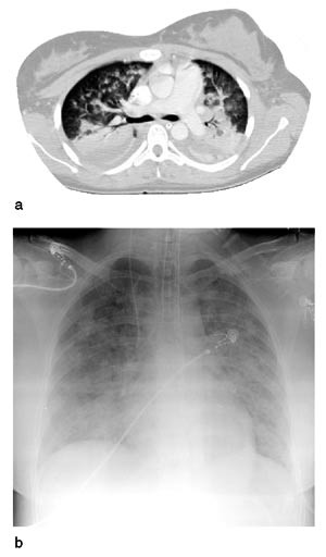 Figur 2  Lungebilder tatt fire dager etter innkomst. a) CT thorax: utbredte, flekkvise parenkymfortetninger, basal&hellip;
