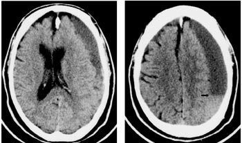 Figur 2  Ny CT&thinsp;-unders&oslash;kelse ved reinnleggelse 15 d&oslash;gn postoperativt. Snitt fra de samme niv&aring;er som i figur 1. Det subdurale&hellip;