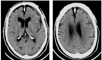 Figur 3  T&thinsp;-unders&oslash;kelse ved kontroll etter et halvt &aring;r, snitt i samme niv&aring;er som i figur 1 og figur 2. Det ses n&aelig;rmest full&hellip;