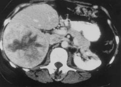 Figur 2  CT-bildet av status tre m&aring;neder etter prim&aelig;roperasjonen. Det er ikke tegn til lokalt residiv i abdomen. Venstre&hellip;