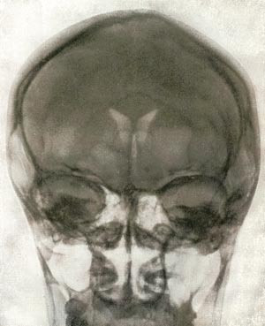 Figur 2  Normalt luftencefalogram, som hevdes &aring; stamme fra Quisling (9). Encefalografien er her gjengitt fra 12. utgave av&hellip;