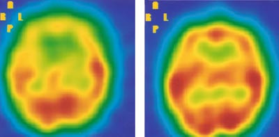 Figur 2  Regional cerebral perfusjon illustrert ved enfotonstomografibilder hos en pasient f&oslash;r og etter operasjon for prim&aelig;r&hellip;