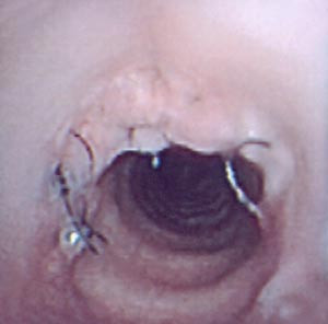 Figur 2  Endoskopisk foto av anastomose tre m&aring;neder postoperativt