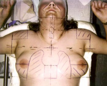 Figur 1  Kappefeltsstr&aring;lebehandling hos en voksen kvinne med lungeblokker. Store deler av de &oslash;vre kvadranter av begge mammae&hellip;