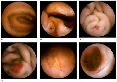 Figur 4  a) Normal tynntarm. Man ser tydelig sirkul&aelig;re folder og villi (tarmtotter). b) Duodenum med papilla Vateri. c)&hellip;