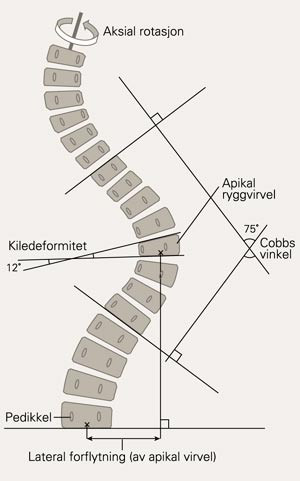Skjematisk fremstilling av de forskjellige variablene som kan m&aring;les p&aring; r&oslash;ntgenbildet av den skoliotiske ryggs&oslash;ylen. Aksial&hellip;