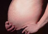 Vektreduserende kirurgi er effektivt for sykelig overvektige. Foto Harald Henden/SCANPIX