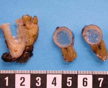 Figur 1  Makroskopisk bilde av mucin&oslash;st cystadenom i appendix. Divertikkel i appendix er ikke gjengitt p&aring; bildet