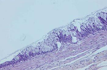 Figur 2  Mikroskopisk bilde av mucin&oslash;st cystadenom i appendix med vekslende celletetthet i epitelet
