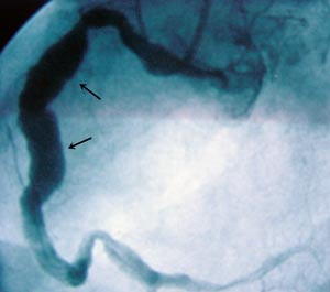 Figur 3  Angiografi av h&oslash;yre koronararterie med dilatasjon av proksimale og midtre avsnitt
