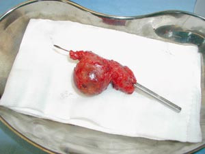 Figur 4  Aneurismatisk del av h&oslash;yre koronararterie etter operasjon. Denne m&aring;lte ca. 3,5 x 3,5 cm i diameter