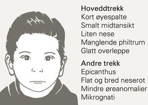 Kliniske karakteristika ved f&oslash;talt alkoholsyndrom