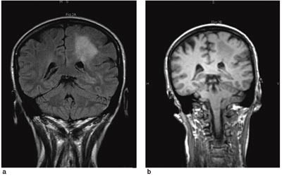 Figur 2  a) Cerebral MR med koronal FLAIR viser en traktformet hyperintens lesjon i hvit substans frontoparietalt i venstre&hellip;