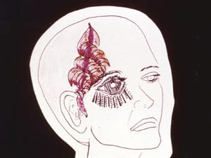 Figur 1  Migrenesmerter (ca. 1964). Miss J.R.B.