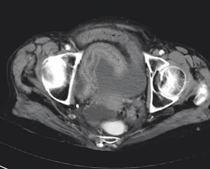 Figur 2  Computertomografiske funn ved strangulasjon: Lagdeling og veggfortykkelse i tynntarm