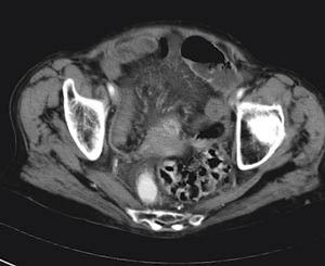 Figur 3  Computertomografiske funn ved strangulasjon: Stuvning i mesenteriet