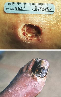 Figur 1  Typisk &laquo;utstanset&raquo; arterielt s&aring;r over malleol hos pasient med perifer aterosklerotisk sykdom (&oslash;verst). Til&hellip;