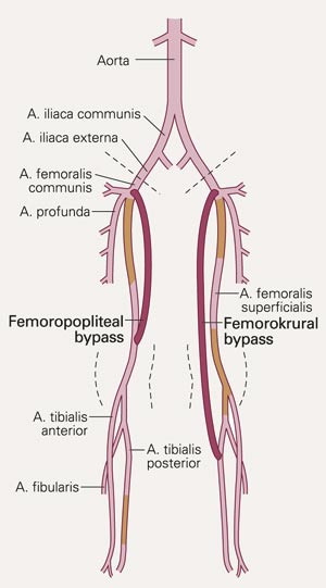 Skjematisk fremstilling av bypass i underekstremitetene, femoropopliteal og femorokrural bypass, hos pasienter med perifer&hellip;