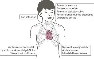 Omr&aring;der for auskultasjon av hjertelyder hos barn