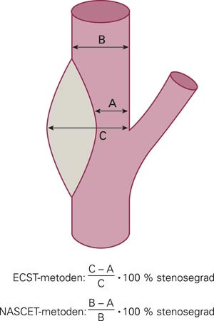 Tegning av carotisbifurkaturen med angivelse av metode for beregning av stenosegrad ved henholdsvis NASCET- og ECST-studiene&hellip;