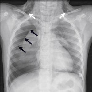 Figur 1  Diffust subkutant emfysem rundt halsen (hvite piler) og h&oslash;yresidig pneumothorax (svarte piler)