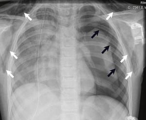 Figur 2  Kontrollbilde etter innleggelse av thoraxdren p&aring; h&oslash;yre side viser tilkommet venstresidig pneumothorax (svarte piler&hellip;