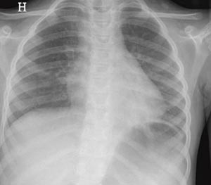 Figur 3  Kontrollbilde sjette postoperative dag viste tilbakegang av det subkutane emfysemet og den bilaterale pneumothorax&hellip;