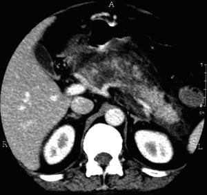 Figur 2  Kontrast-CT. Etylutl&oslash;yst akutt nekrotiserande pankreatitt. Etter 3&thinsp;&ndash;&thinsp;5 dagar er det ytterlegare reaksjon i&hellip;