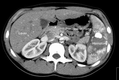 Figur 2a  CT-&thinsp;unders&oslash;kelse av pasient 1 i arteriell fase med pseudoaneurisme og hematom i milten