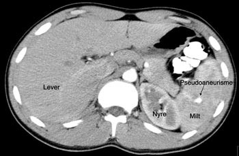 Figur 5  Kontrollunders&oslash;kelse av samme pasient 6. dag; hilusn&aelig;rt pseudoaneurisme