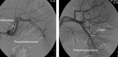 Figur 6  Angiogram f&oslash;r og etter coiling av pseudoaneurisme i milten hos pasient 2