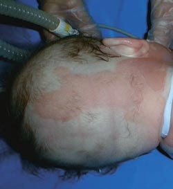 Figur 1  F&oslash;rstegradsskade/epidermal skade. Bakhodet til fire m&aring;neder gammelt spedbarn med skoldingsskade. Foto Guro Vaagb&oslash;,&hellip;