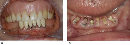 Figur 1  a) Pasienten har en kostbar bro i underkjeven. b) Manglende tannstell gj&oslash;r at broen knekker tvert av