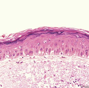Figur 1  Hematoksylin-/eosinfargede snitt av aktinisk keratose med lett atypisk epitelproliferasjon. Epidermis er tynn&hellip;